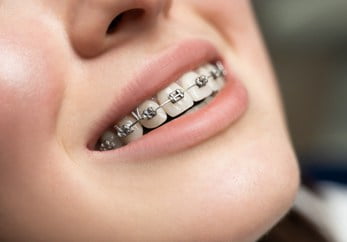 3 Advantages of Choosing Clear Aligners Over Traditional Braces: Chester  Family Dentistry: General Dentists