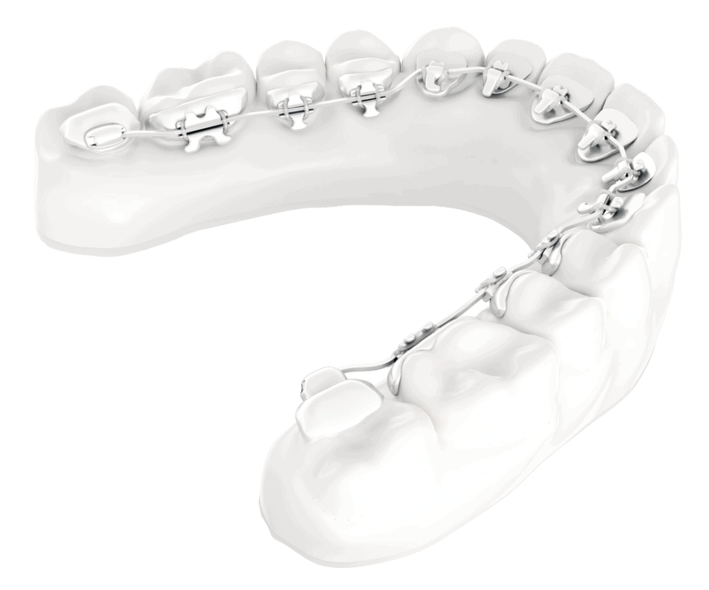 5 Fantastic Benefits of Lingual Braces