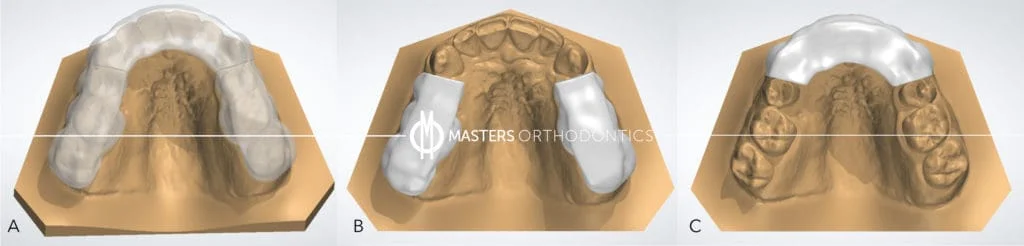 How Occlusal Splints Work For My Practice - Masters Orthodontics