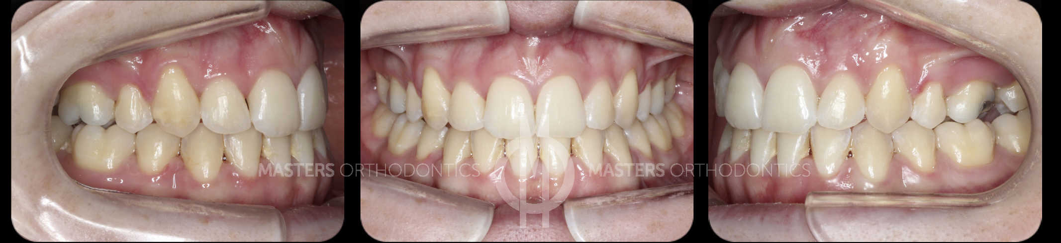 Before and after orthodontic treatment - Mid-Wessex Orthodontics